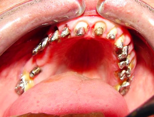 Modulo grado superior protesis dentales